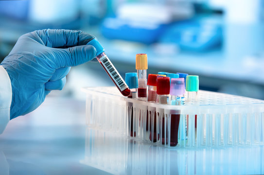 Hepatitis B Diagnosis
